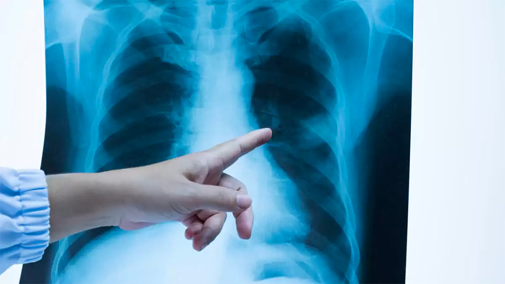 Tuberculosis: el diagnóstico temprano reduce las chances de vivir con secuelas permanentes 
