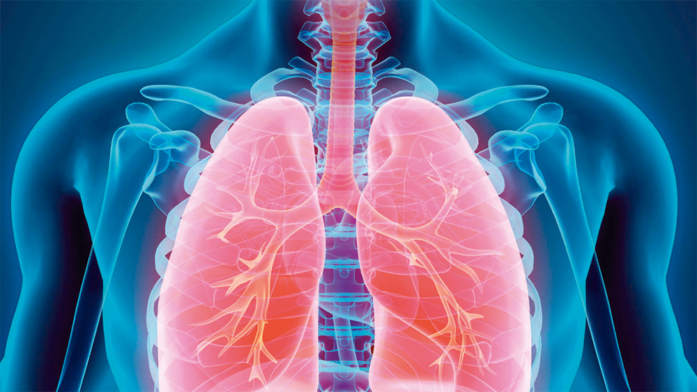 Fibrosis Pulmonar Idiopática, el gran desafío del diagnóstico temprano