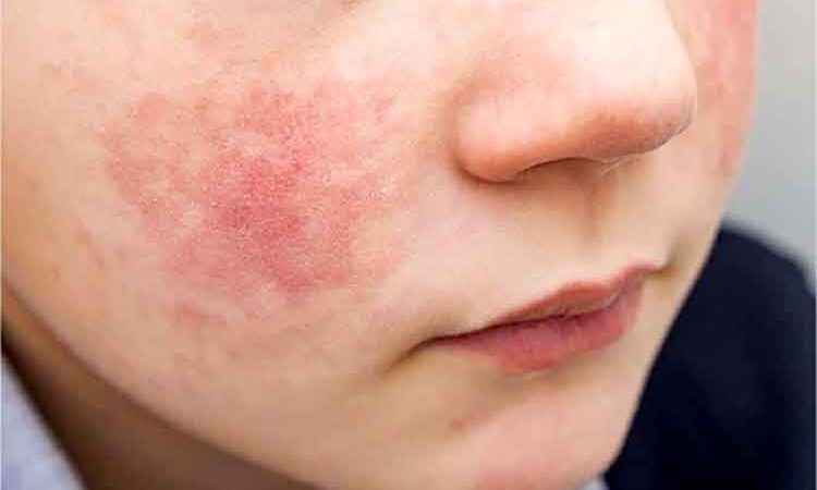 Genodermatosis, una enfermedad rara que afecta la piel y al menos una de cada cuatro familias padece