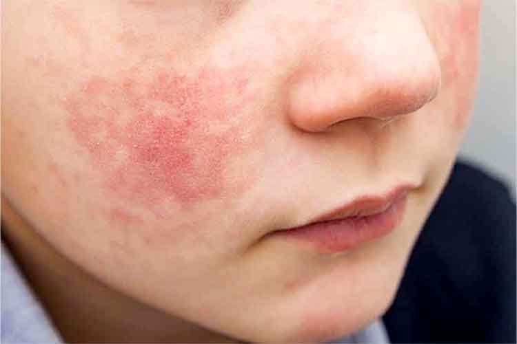 Genodermatosis, una enfermedad rara que afecta la piel y al menos una de cada cuatro familias padece