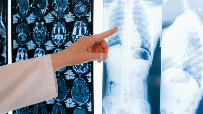 Estudios para prevenir el cáncer de pulmón podrían sumarse a los chequeos de rutina